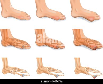 Illustrazione vettoriale di artrite, artrosi dell'alluce Illustrazione Vettoriale
