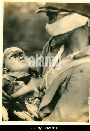 Bambino ferito Hibakusha superstiti vittime del bombardamento atomico di Hiroshima, Giappone, 1945 Foto Stock