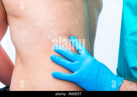 Close up medico dermatologo mani in guanti esamina la depigmentazione cutanea sulla Le Mans indietro. Messa a fuoco selettiva. spazio copia Foto Stock