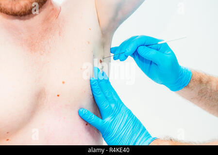 Close up medico dermatologo mani in guanti esamina le ascelle birthmark del paziente di sesso maschile in clinica. Controllo benigne moli. Concetto di cancro. Selective Foto Stock