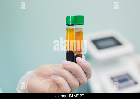 Preparazione per Plasmolifting. Provette per prelievo ematico in due strati divisi per centrifugazione dopo la manipolazione di personalizzazione. Foto Stock