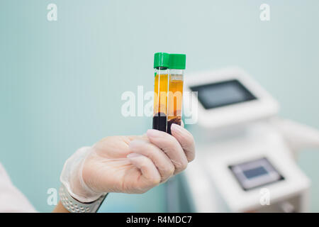 Preparazione per Plasmolifting. Provette per prelievo ematico in due strati divisi per centrifugazione dopo la manipolazione di personalizzazione. Foto Stock