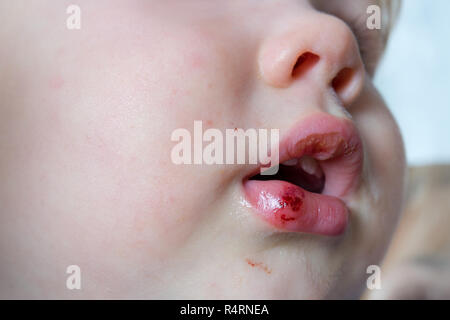 Close-up di baby contuso labbro ferito dopo la caduta. Bambini I traumi del concetto. Foto Stock