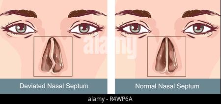 Il setto nasale Treatmen deviazione Illustrazione Vettoriale