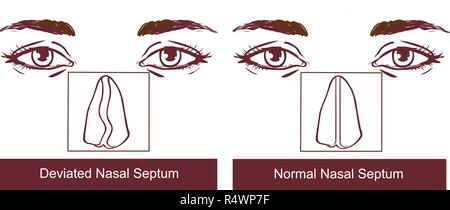 Il setto nasale Treatmen deviazione Illustrazione Vettoriale