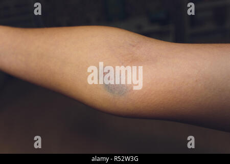 Lividi da raccolta del sangue isolate. Viola livido sul braccio. Foto Stock