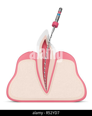 3D render del dente con file endodontico in le gengive. Trattamento canalare concetto. Foto Stock