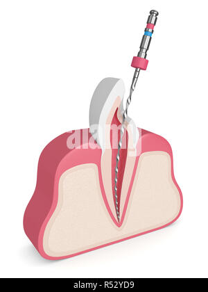 3D render del dente con file endodontico in le gengive. Trattamento canalare concetto. Foto Stock