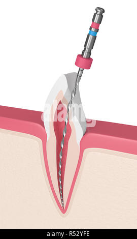 3D render del dente con file endodontico in le gengive. Trattamento canalare concetto. Foto Stock