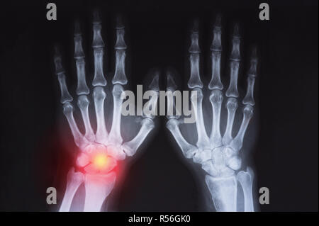 Umani della mano x ray evidenziato in rosso Foto Stock