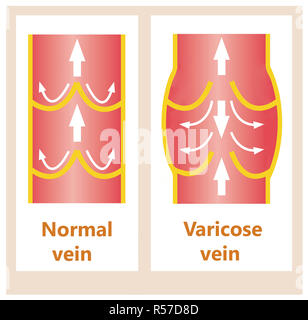 Le vene varicose e le vene normale Foto Stock