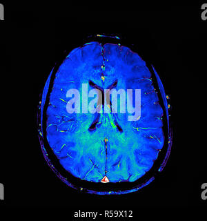 Colorato di risonanza magnetica (RM) scansione di una sezione sagittale attraverso una testa del paziente che mostra un sano cervello umano. Foto Stock
