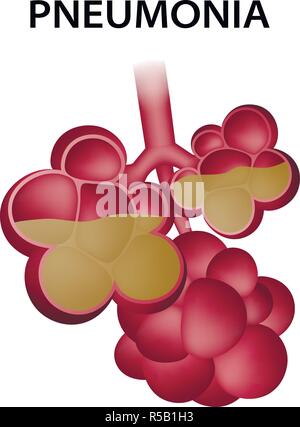 La polmonite alveoli icona. Illustrazione realistica di polmonite negli alveoli icona vettoriali per il web design isolato su sfondo bianco Illustrazione Vettoriale