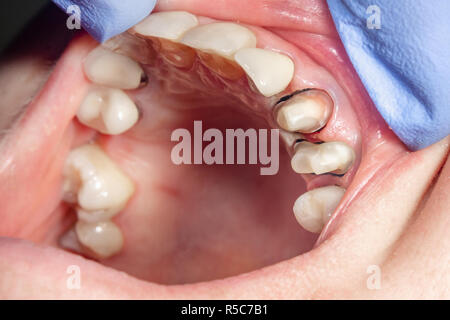 Perno odontoiatrico close-up, la preparazione del dente per la formulazione della corona in ceramica. Il concetto di protesi in odontoiatria Foto Stock