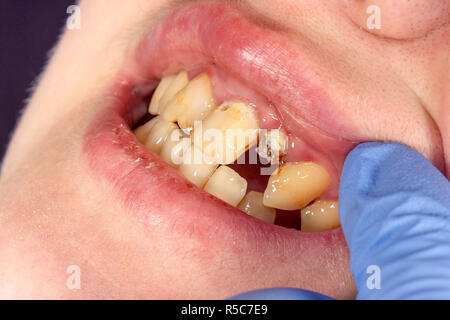 Perno odontoiatrico close-up, la preparazione del dente per la formulazione della corona in ceramica. Il concetto di protesi in odontoiatria Foto Stock