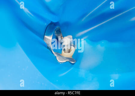 Perno odontoiatrico close-up, la preparazione del dente per la formulazione della corona in ceramica. Il concetto di protesi in odontoiatria Foto Stock