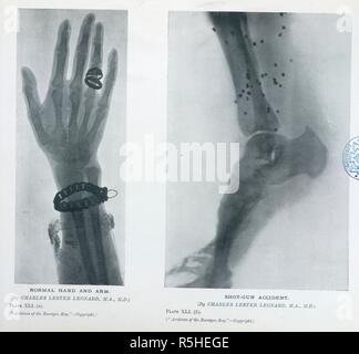 Piastra XLI. (A). Il normale della mano e del braccio. (Da Charles Lester Leonard, M.A; M.D.) Piastra XLI. (B). Shot-gun incidente. Archivi del Roentgen ray. London : Heinemann, 1897-1915. Fonte: 1640.750000 vol. II 113. Foto Stock