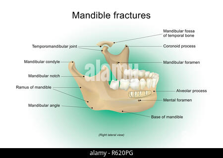 Anatomia della mandibola fratture. Foto Stock