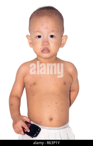 Baby boy con la varicella Foto Stock