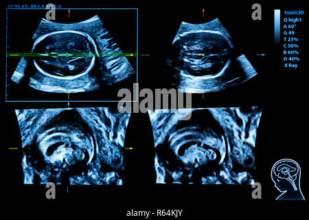 Immagine colorata dei moderni monitor ad ultrasuoni. Ecografia macchina. Alta tecnologia medica e attrezzature sanitarie. Imaging a ultrasuoni o sonogra Foto Stock