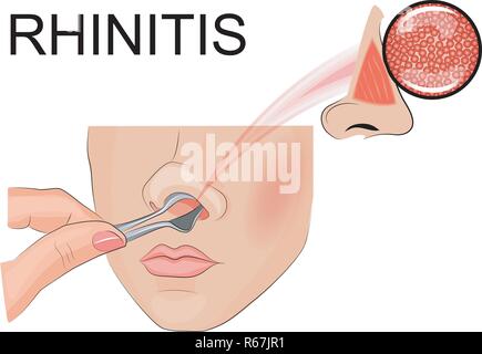 Illustrazione di ispezione della cavità nasale Illustrazione Vettoriale