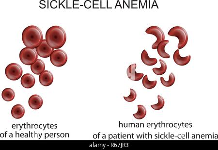Illustrazione di cellule del sangue in malattia anemia falciforme Illustrazione Vettoriale