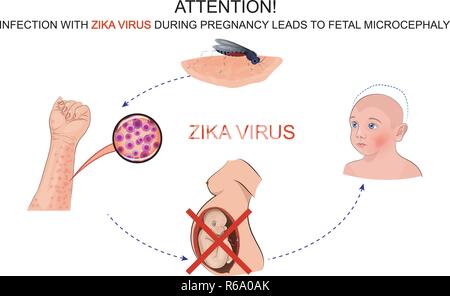 Illustrazione degli effetti di una infezione da virus di zika per donne in stato di gravidanza Illustrazione Vettoriale