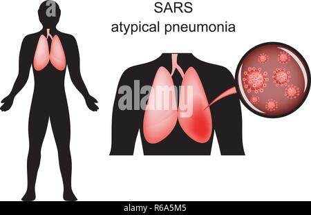 Illustrazione della SARS. infiammazione dei polmoni e l'agente causativo. virus Illustrazione Vettoriale