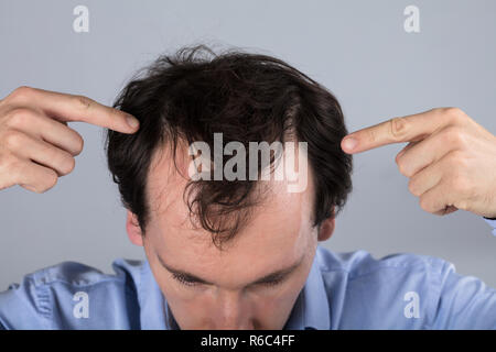 Uomo con la perdita dei capelli i sintomi Foto Stock