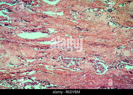 Tiroide carcinoma scirrhous tessuto malato 100x Foto Stock