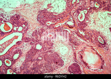 Tumore misto della ghiandola parotide tessuto malato 100x Foto Stock