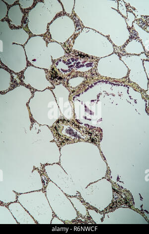 Polmone con asma in d3m microscopio Foto Stock