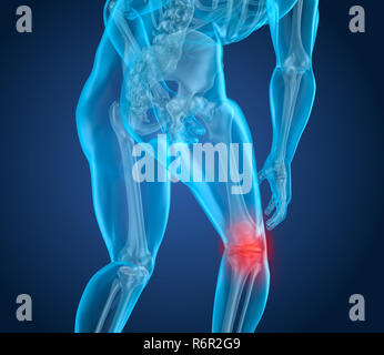 Il dolore al ginocchio attacco, l'uomo che soffre di ginocchio spinale. 3D illustrazione Foto Stock