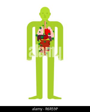 Malati organo interno anatomia di una malattia umana. Cuore e polmoni. Fegato e stomaco. L'esofago e il pancreas. Rene e milza. Dolorante di virus e bacter Illustrazione Vettoriale