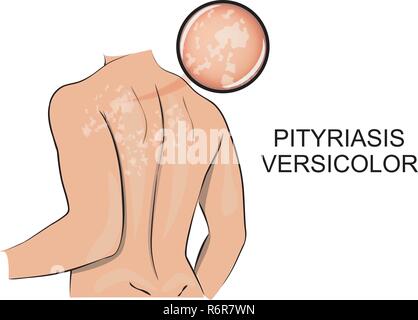 Immagine del lato posteriore, l'interessato la pityriasis versicolor. dermatologia. Illustrazione Vettoriale