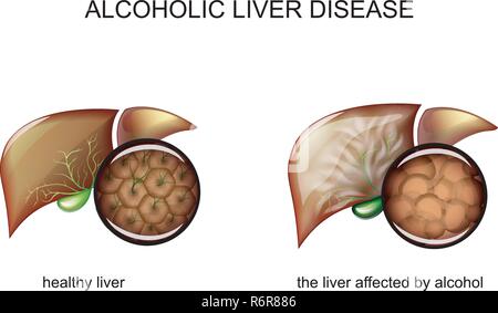 Illustrazione di un fegato sano e cirrosi alcolica Illustrazione Vettoriale