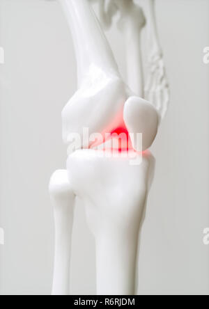 Osteoartrite del ginocchio coperto - 3D Rendering Foto Stock