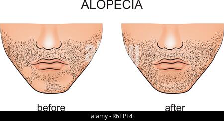 Illustrazione di alopecia areata sul maschio mento Illustrazione Vettoriale