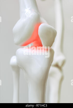 Osteoartrite del ginocchio coperto - 3D Rendering Foto Stock