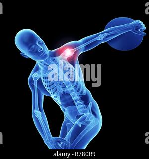 3d reso illustrazione di un atleta di spalla dolorosa. Foto Stock
