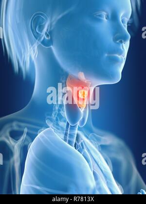 3d reso illustrazione della femmina del cancro della laringe. Foto Stock