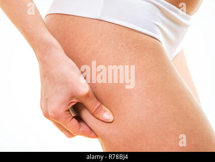 Donna cellulite controllo sulle sue natiche Foto Stock