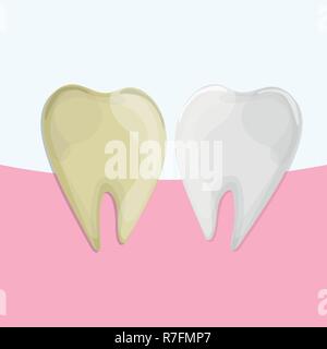 Professional lo sbiancamento dei denti, sano e dente di giallo, illustrazione vettoriale Illustrazione Vettoriale