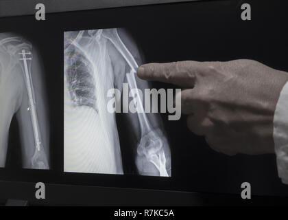 Sullo schermo del monitor è visualizzata una xray di frattura di una mano con la mano di un medico che puntano a una frattura. La seconda immagine sullo schermo è h Foto Stock