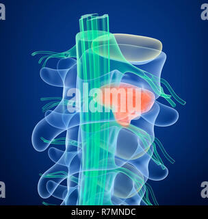 Il midollo spinale sotto pressione di rigonfiamento del disco, 3D illustrazione Foto Stock
