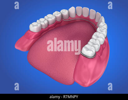 Parziale rimovibile dentiera. Accurata dal punto di vista medico 3D illustrazione Foto Stock