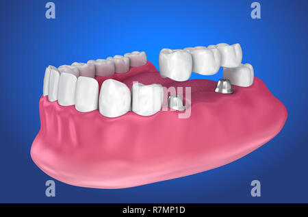 Impianto supportato fisso bridge. Accurata dal punto di vista medico 3D illustrazione Foto Stock