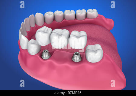 Impianto supportato fisso bridge. Accurata dal punto di vista medico 3D illustrazione Foto Stock