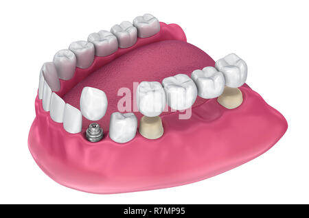 Dente supportato fisso bridge, impianto e corona. Accurata dal punto di vista medico 3D illustrazione Foto Stock