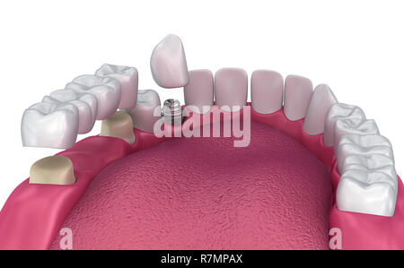 Dente supportato fisso bridge, impianto e corona. Accurata dal punto di vista medico 3D illustrazione Foto Stock